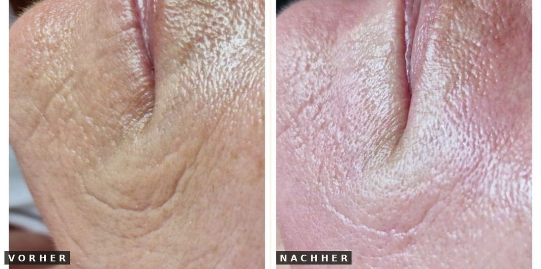 Microneedling Hals vorher nachher