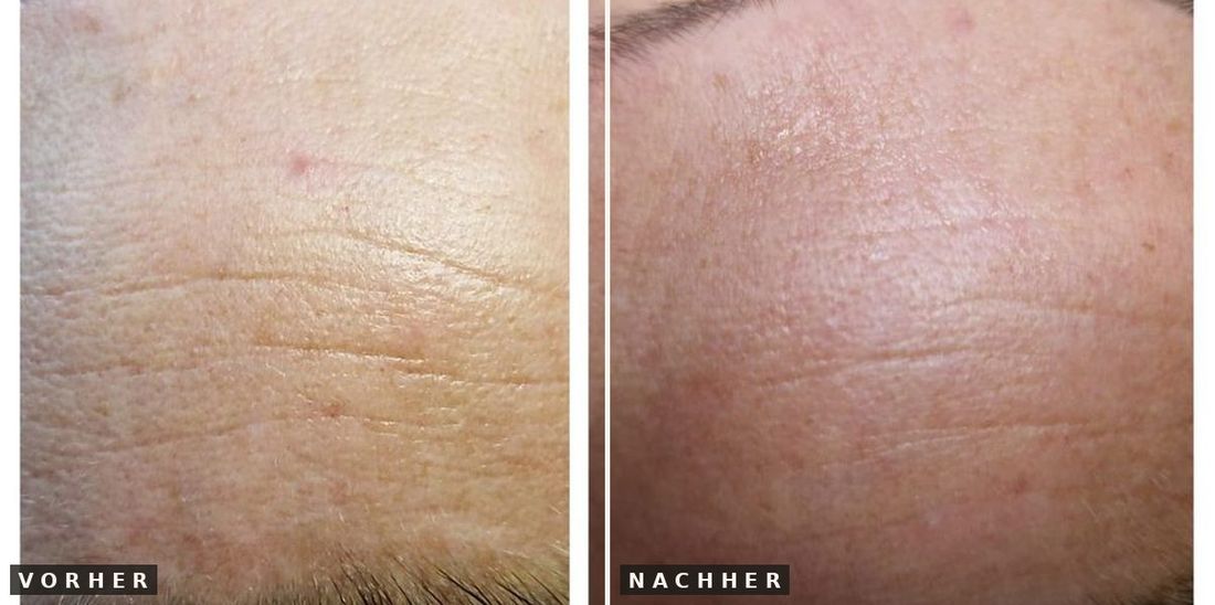 Microneedling Stirn vorher nachher