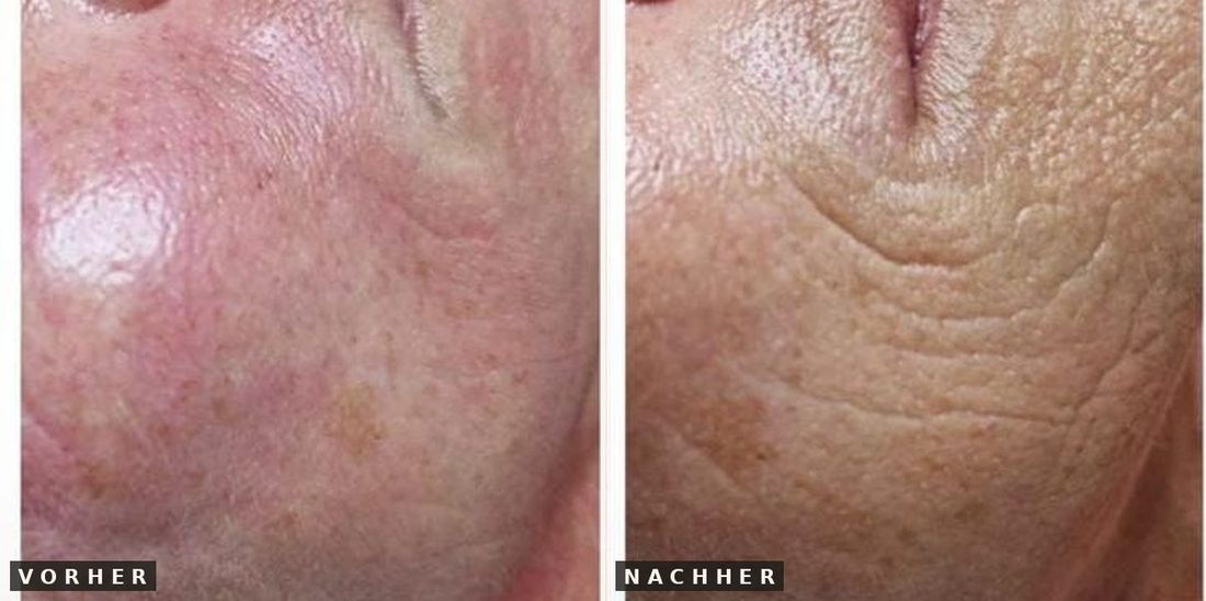 Microneedling Wange vorher nachher