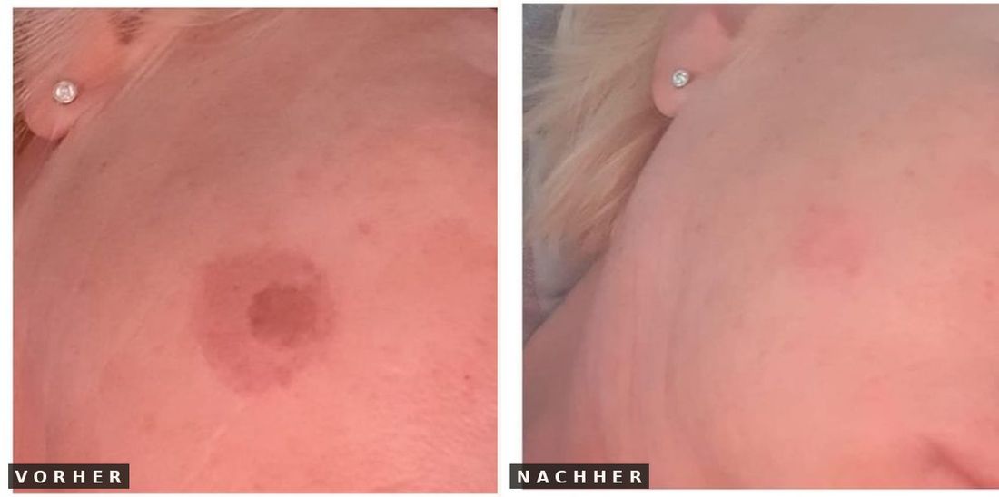 Pigmentfleck vorher nachher