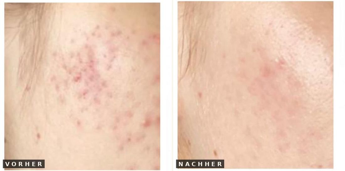 Unreinheiten vorher nachher